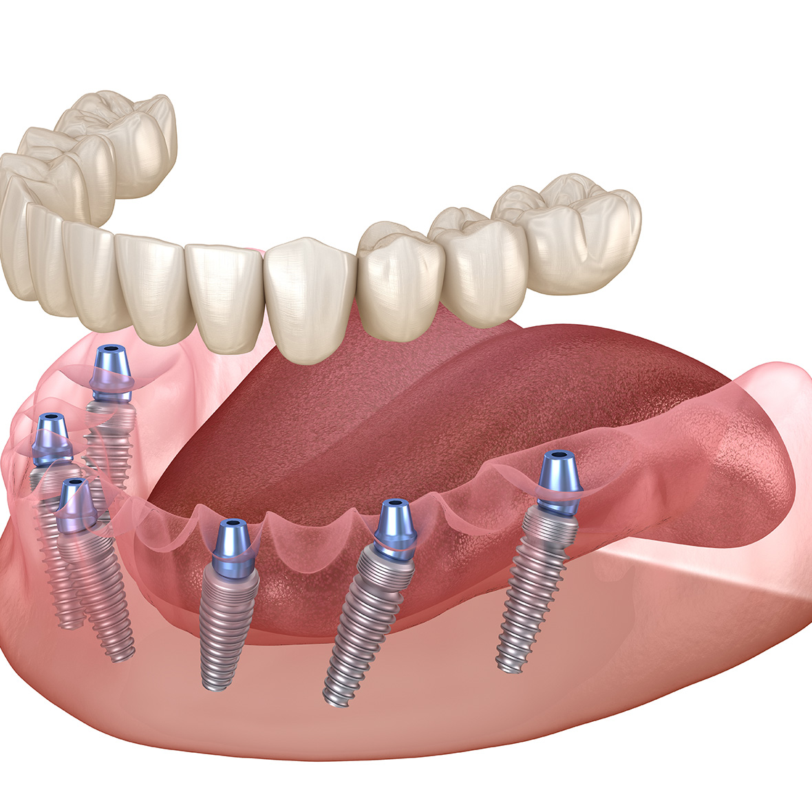 All-on-6 fogpótlási megoldás fogimplantátummal.